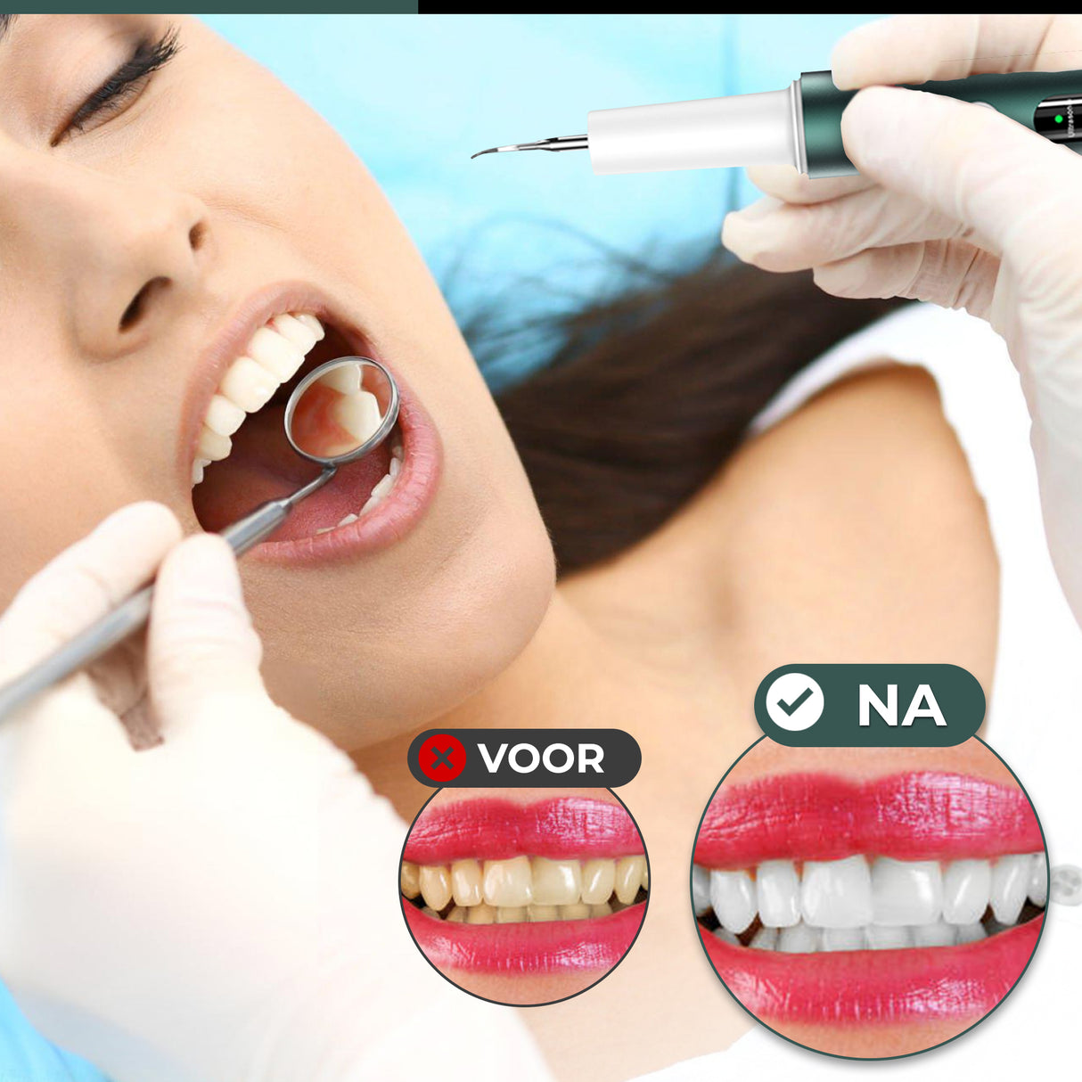 Retourdeal - My Green Deal - Tandsteenverwijderaar